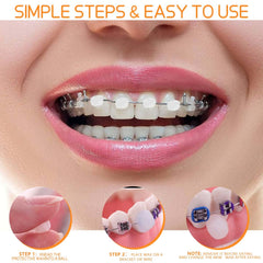 Close-up of clear blend braces wax blending with teeth