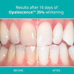 Close-up of Opalescence 35% gel syringe tip