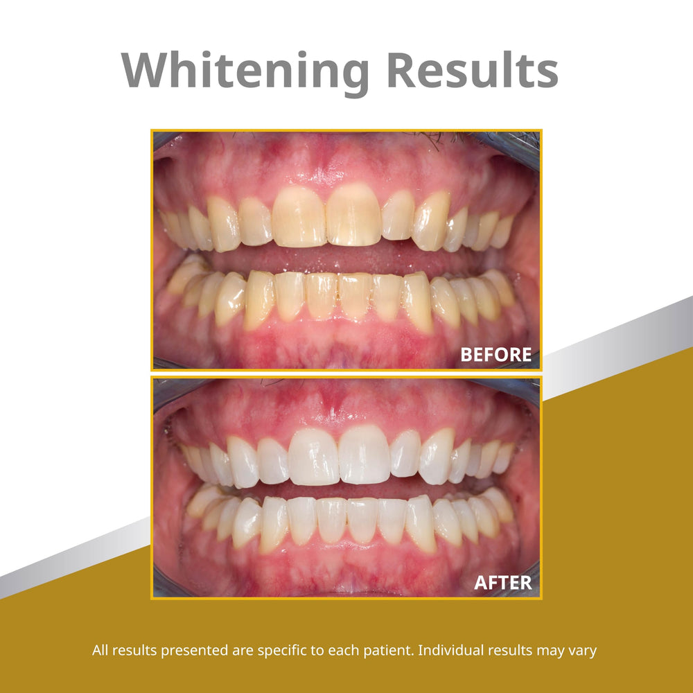 Gel staying in tray during application illustration