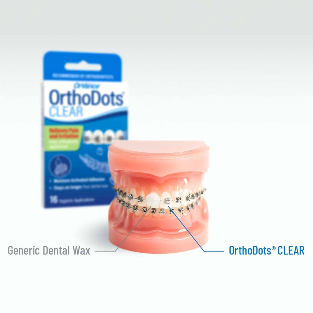 OrthoDots used with clear aligners for irritation relief