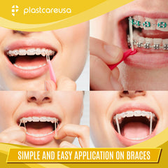Orthodontic elastics kit used for gap closure and teeth alignment with braces