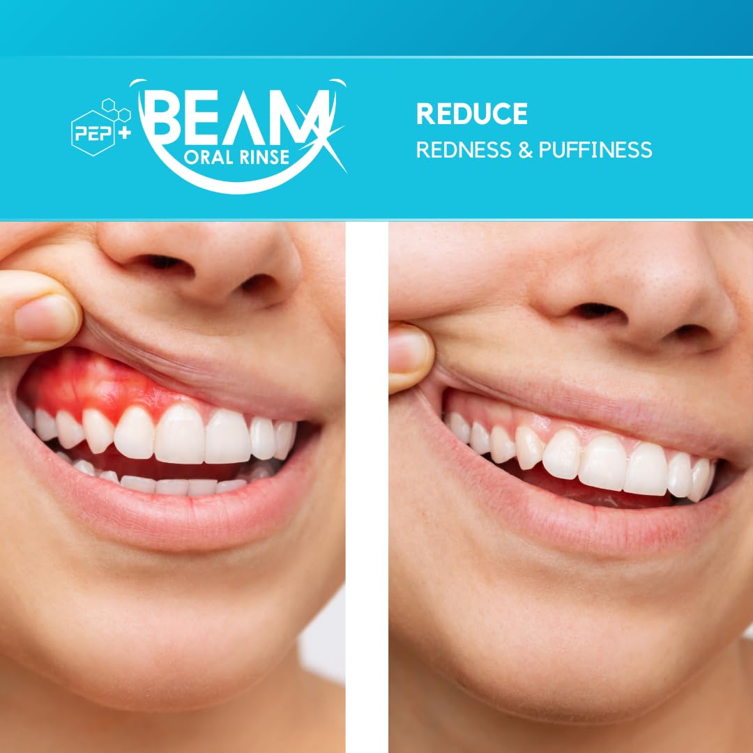 Illustration of enamel strengthening with PEP+ BEAM