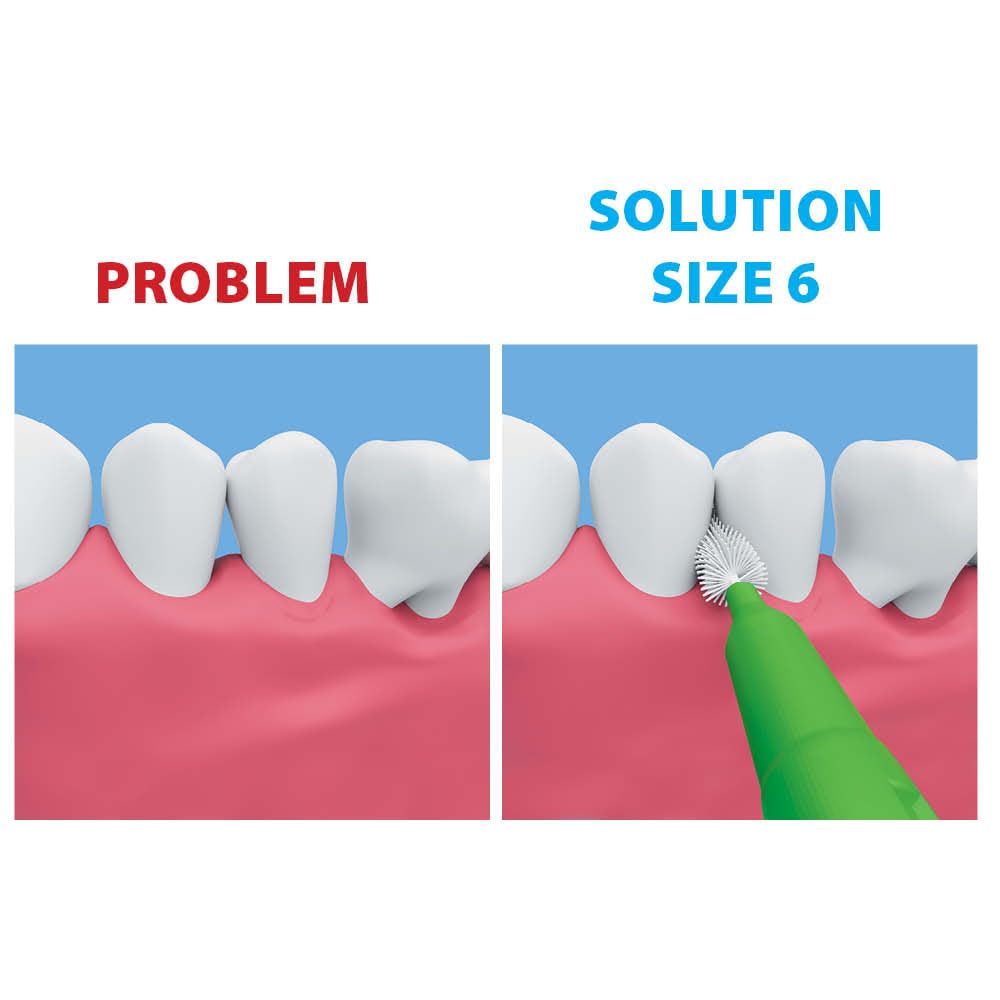 Braces-friendly interdental brushing with Piksters
