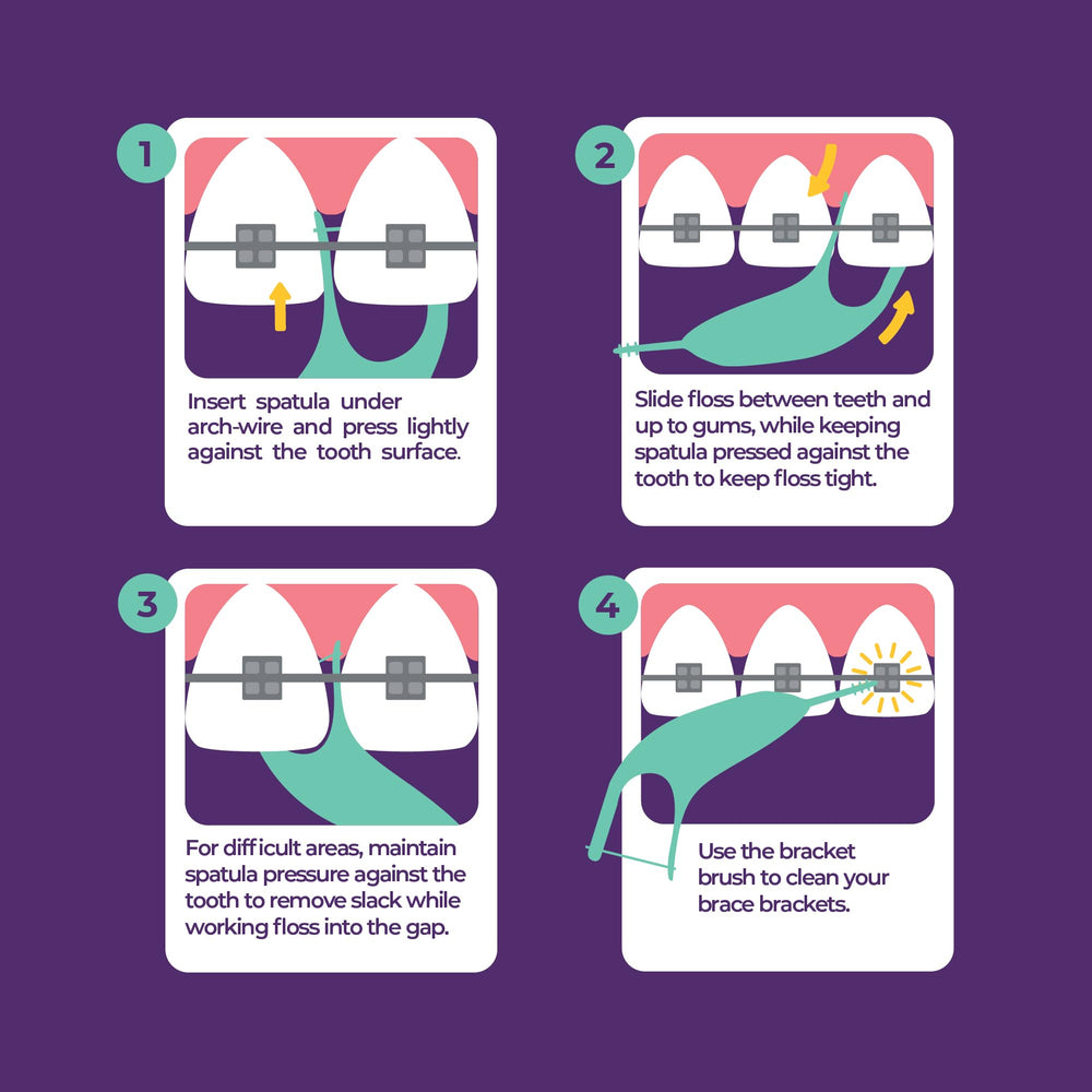 Flossers removing food particles around braces brackets