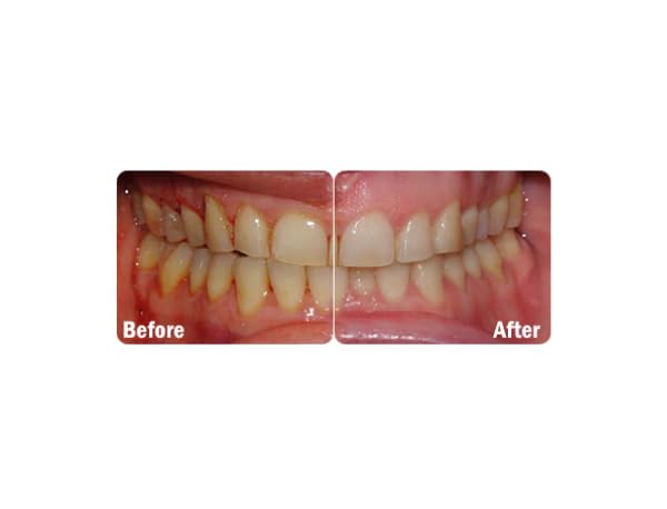 Fresh breath and whiter teeth with ProBiora Kids