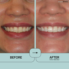 Applying Prostrips to right side of teeth