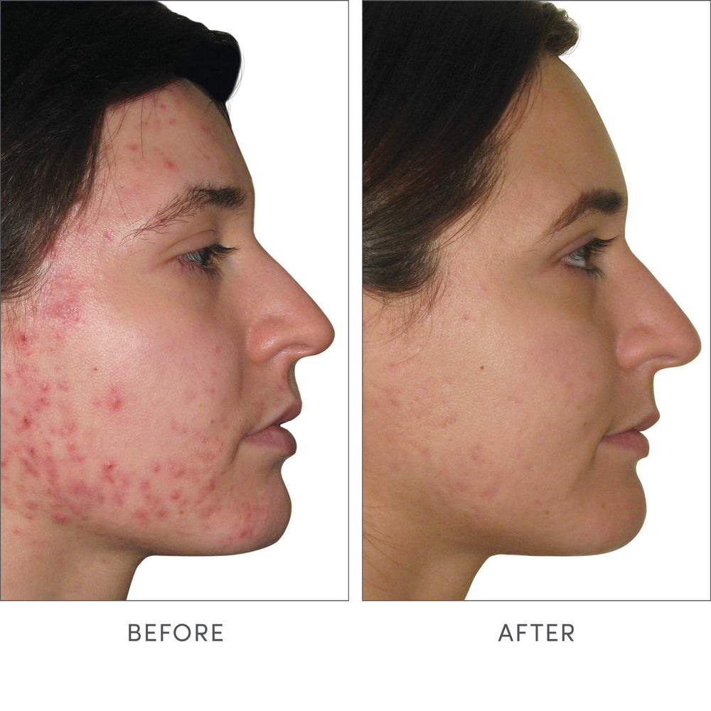 Illustration of skin health benefits and blemish reduction