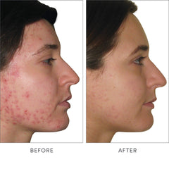 Illustration of skin health benefits and blemish reduction