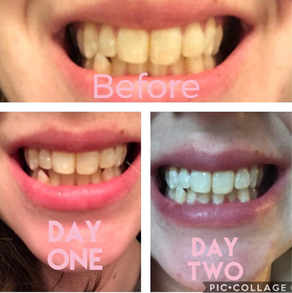 Smile Titan LED whitening light in use