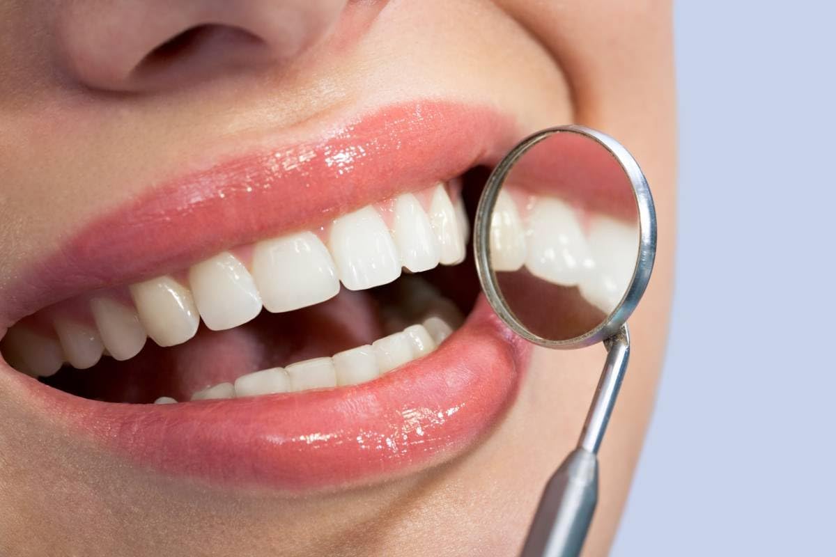 Smiling with a denture kit result after home use.