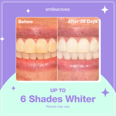 Whitening gel applied to teeth with precision brush