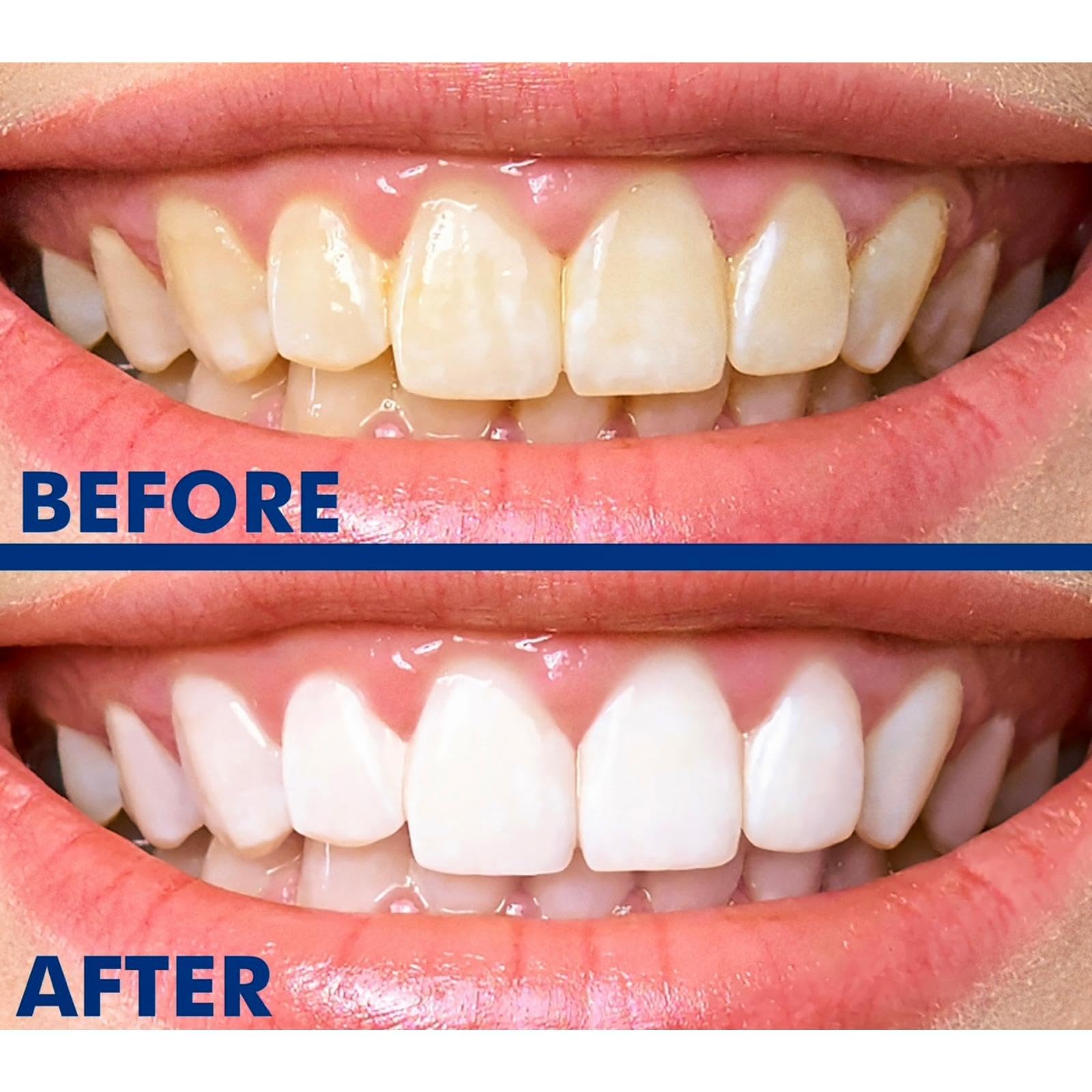 Travel-friendly SmileWhite teeth whitening pen