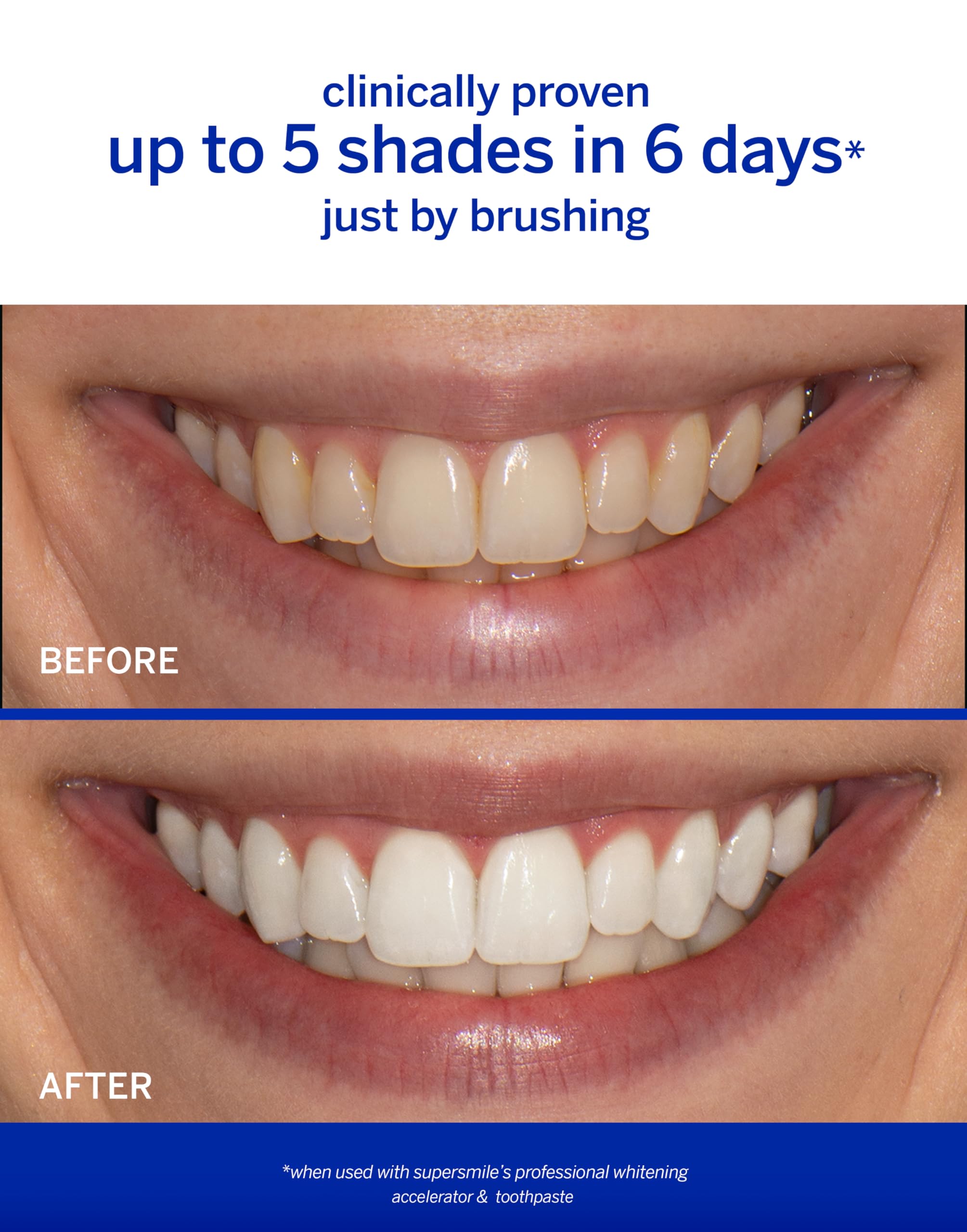Calprox whitening ingredient dissolving the protein layer on teeth