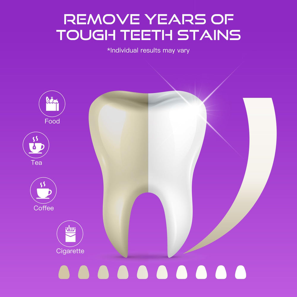 Upper and lower whitening strips applied to teeth for whitening