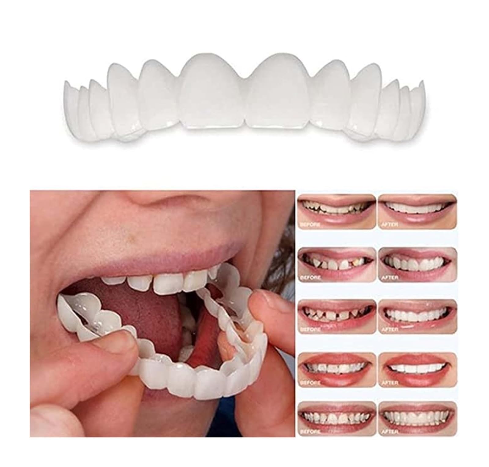 Whitening gel syringes and mouth trays