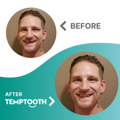 Temptooth shade matching in progress