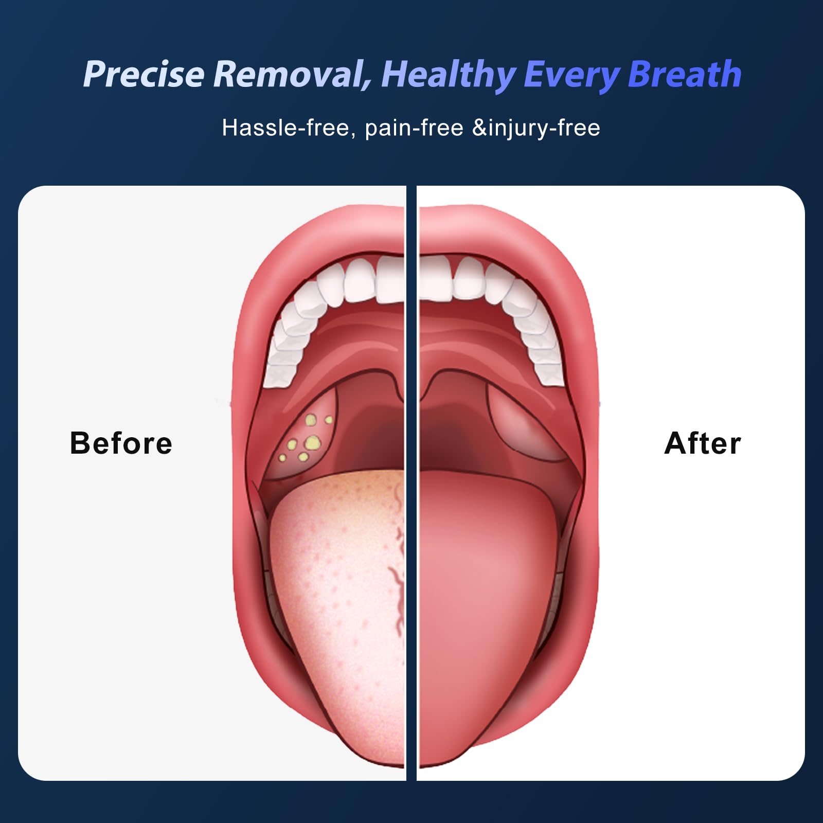 Electric vacuum suction with adjustable power for tonsil stones