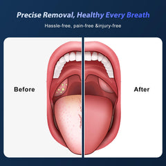 Electric vacuum suction with adjustable power for tonsil stones