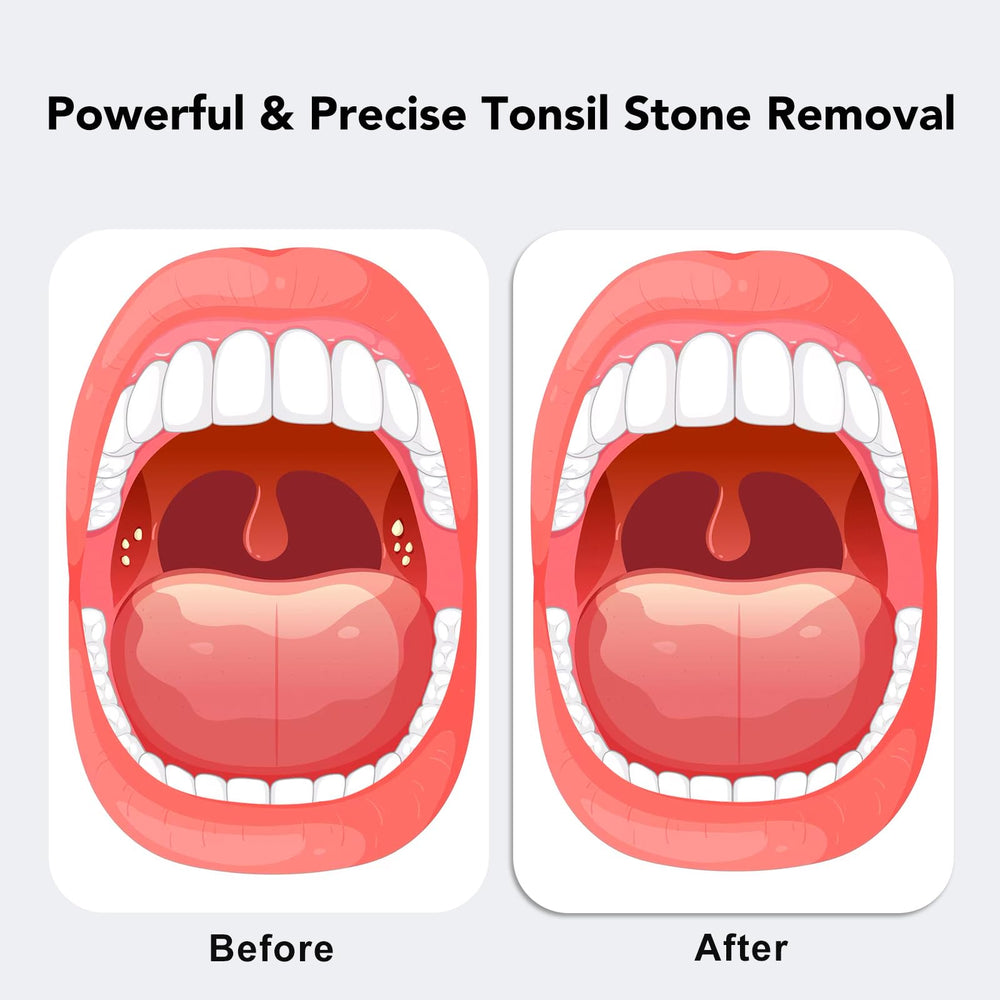 Tonsil stone remover with built-in LED light for clear visibility