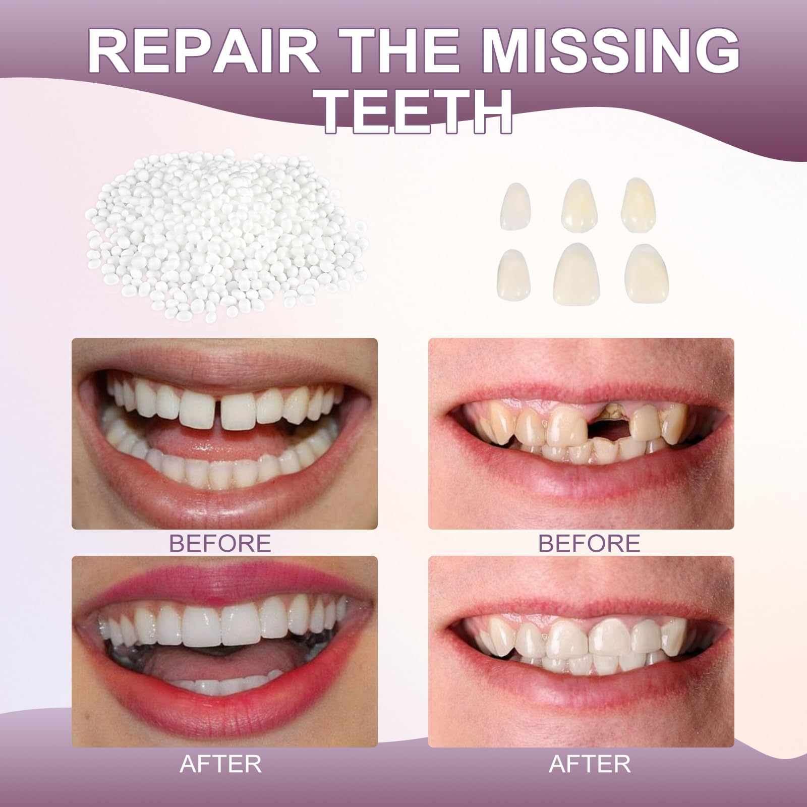 Colored tooth-matching pieces included in the kit