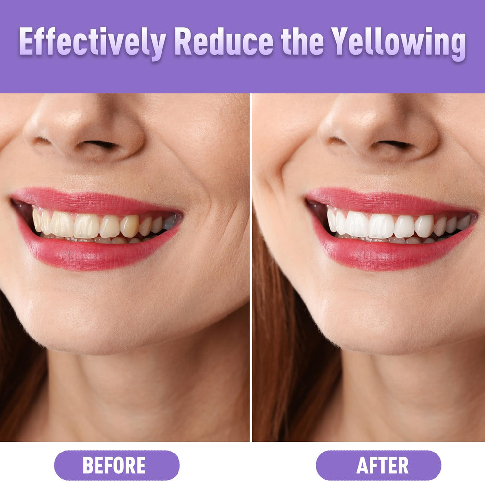 Close-up of whitening gel being applied to teeth