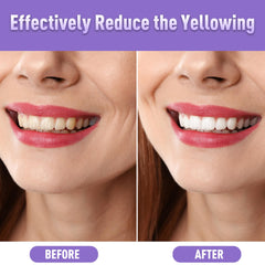 Close-up of whitening gel being applied to teeth