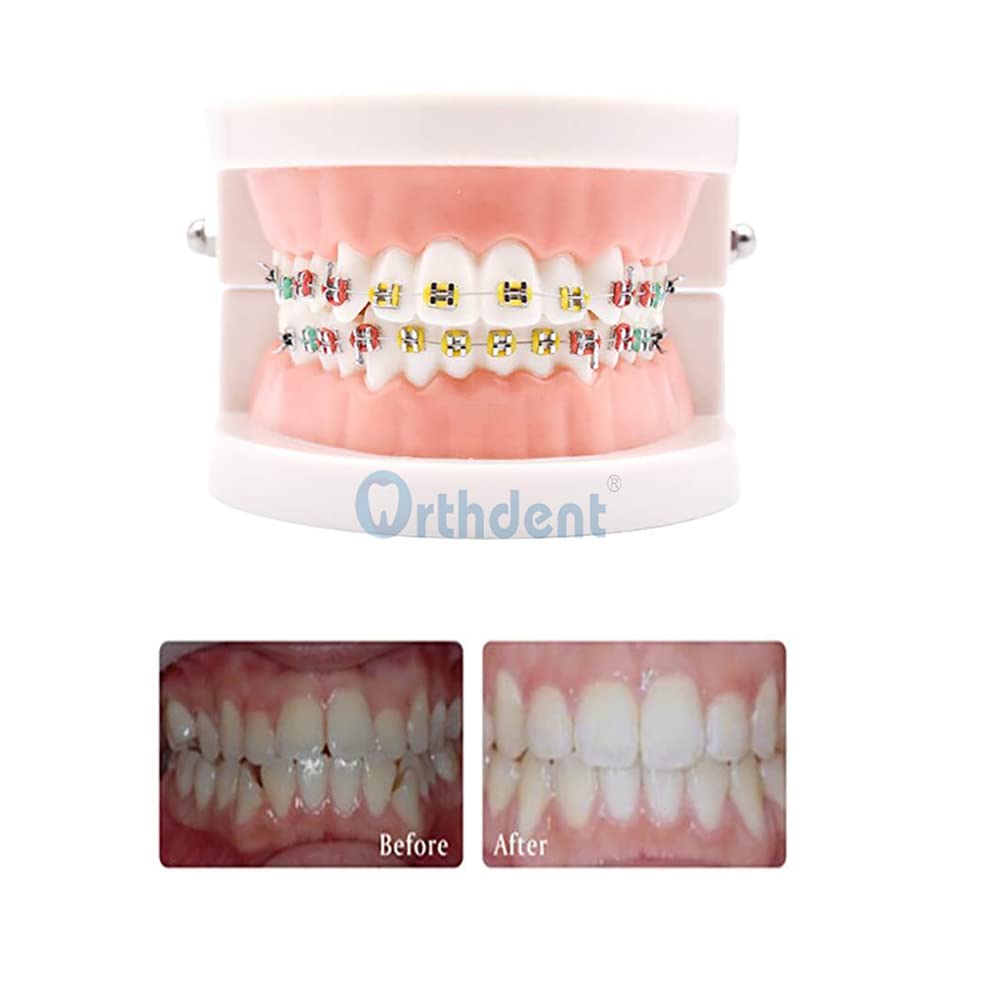 Low-profile ligature ties designed to fit under bracket wings and avoid gum irritation.