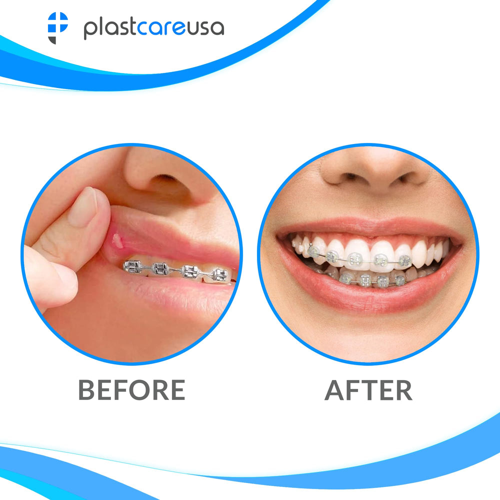 Dentist-endorsed unscented orthodontic wax for braces