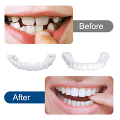 Close-up of comfortable fit veneers