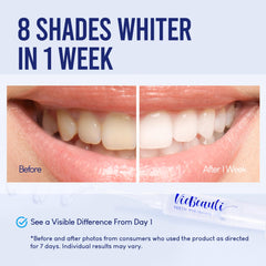 Wireless LED accelerator light for at-home whitening