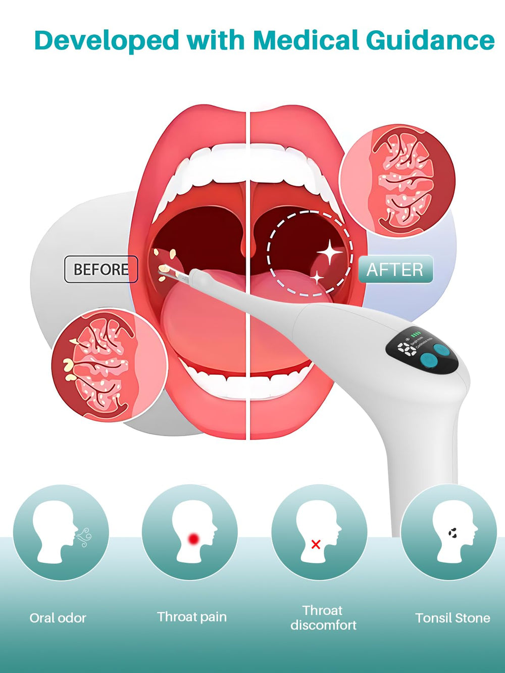 Compact home-use tonsil stone removal kit with camera