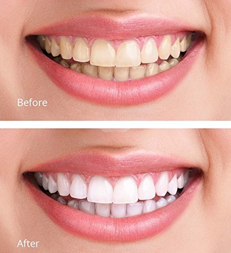Instruction sheet included with White Teeth Global whitening kit.