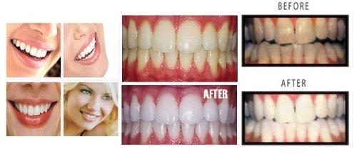 Whitening tray in use with Whiter Smile Labs gel