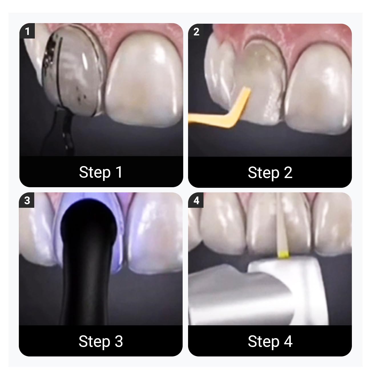 Complete 32-piece Wokyo veneers mould kit